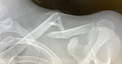Clavicle Fracture Surgery: When is it Necessary?