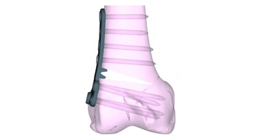 Distal Femoral Osteotomy: A Joint-Preserving Option for Knock-Knee Alignment