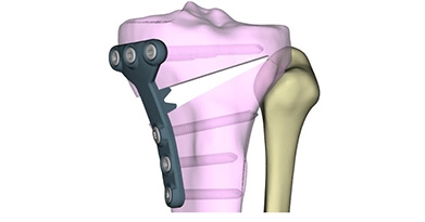 High Tibial Osteotomy: Realigning the Knee to Relieve Pain and Preserve Your Joint