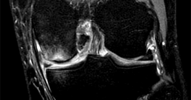 How Do You Treat Subchondral Knee Fractures?