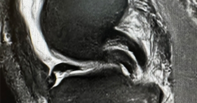 How Serious is a Bucket Handle Meniscus Tear?