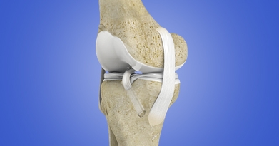 The best tips for ACL reconstruction