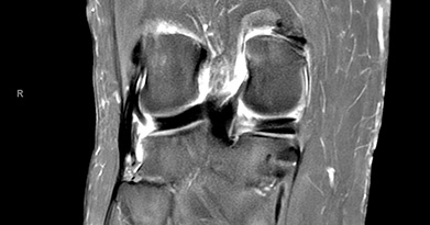 Understanding the Gravity: How Serious Is a Meniscal Root Tear?
