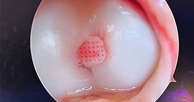 What does CartiHeal do?