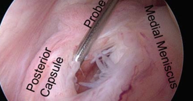 What is a Meniscal Ramp Tear?