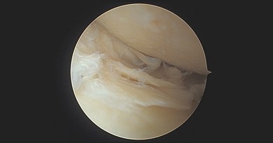 What is the treatment for a degenerative meniscal tear?
