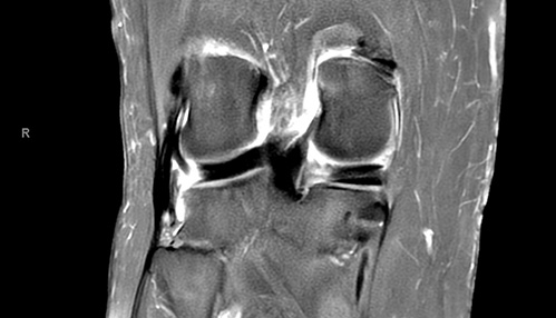 Understanding the Gravity: How Serious Is a Meniscal Root Tear?