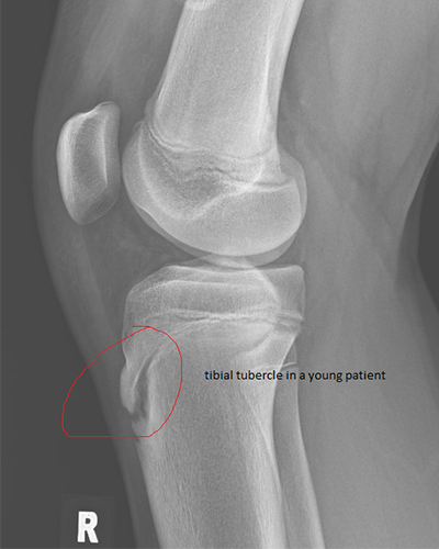Osgood Schlatter Disease Xray Osgood Schlatter Disease Xray