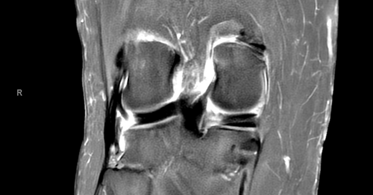 Understanding the Gravity: How Serious Is a Meniscal Root Tear?